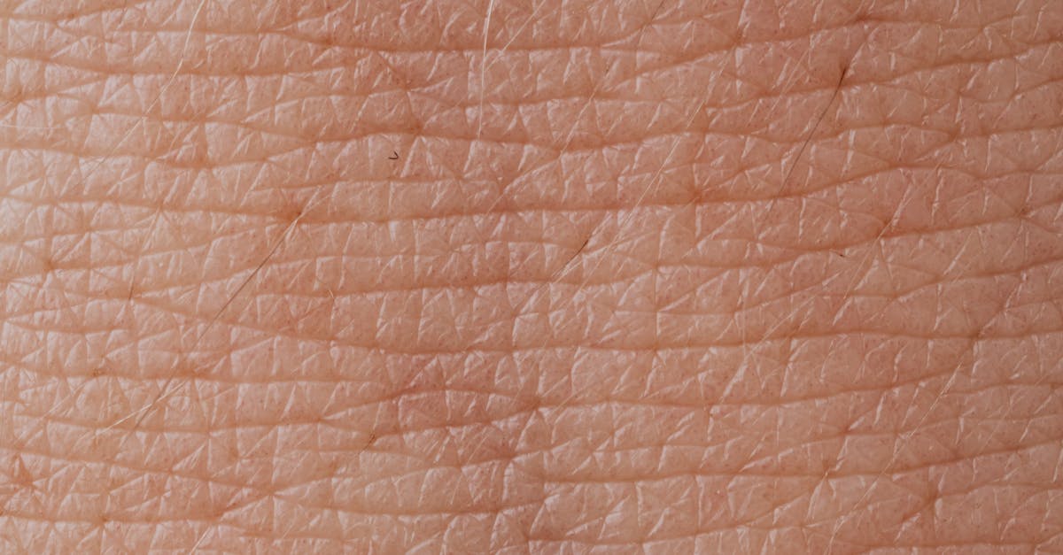 Acneea inversă: o afecțiune dermatologică severă și frecvent subdiagnosticată