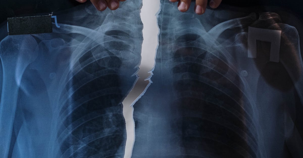 Cancerul pulmonar: expert medical atrage atenția asupra lacunelor sistemului de sănătate