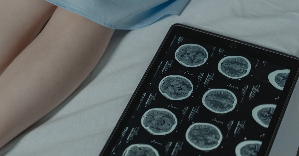 Inteligența artificială, soluție inovatoare pentru depistarea cancerului laringian