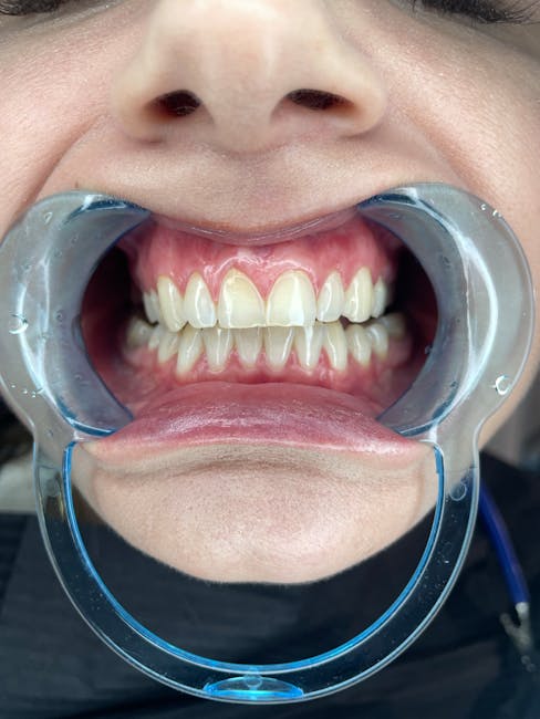 Importanța detartrajului semestrial pentru sănătatea dentară și albirea dinților